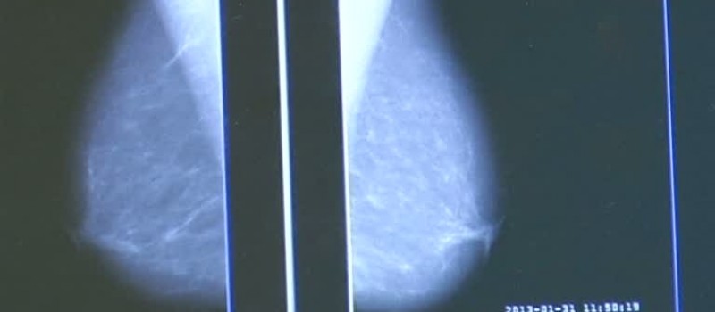 BEZPŁATNA MAMMOGRAFIA